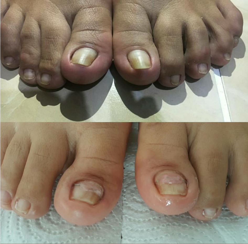 Batık Tırnak Bakımı